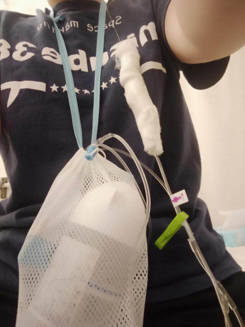 画像に alt 属性が指定されていません。ファイル名: reoperation5-500x667.jpg