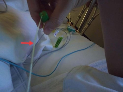 画像に alt 属性が指定されていません。ファイル名: reoperation6-500x375.jpg